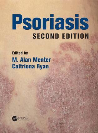 M. Alan Menter, Caitriona Ryan - Psoriasis, Inbunden. Tillgänglighet: Lägg i varukorg