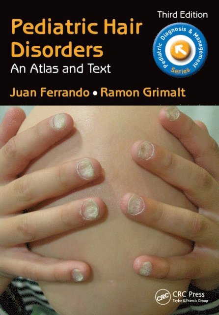 Ramon Grimalt, Juan Ferrando - Pediatric Hair Disorders, E-bok