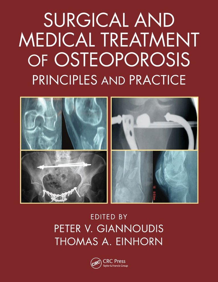 Peter V. Giannoudis, Thomas A. Einhorn - Surgical and Medical Treatment of Osteoporosis, E-bok