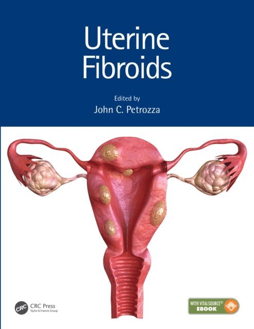 John C. Petrozza - Uterine Fibroids, E-bok
