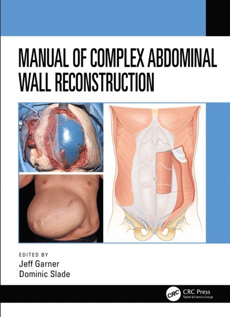 Dominic Slade, Jeff Garner - Manual of Complex Abdominal Wall Reconstruction, E-bok