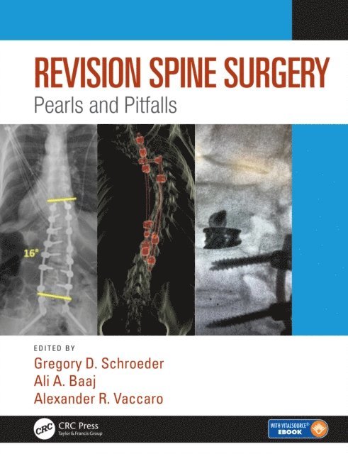 Alexander R. Vaccaro, Ali A. Baaj, Gregory D. Schroeder - Revision Spine Surgery, E-bok