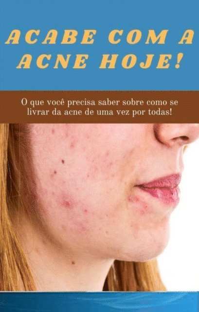 Sharon Burns - Acabe com a acne hoje!, E-bok