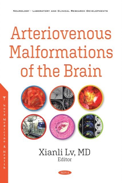 Xianli Lv - Arteriovenous Malformations of the Brain, E-bok