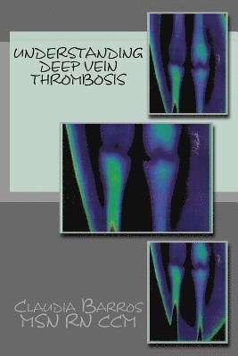 Claudia Barros - Understanding Deep Vein Thrombosis, Häftad