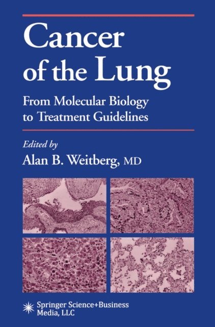 Alan Weitberg - Cancer of the Lung, E-bok