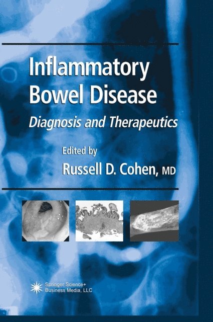 Russell D. Cohen - Inflammatory Bowel Disease, E-bok