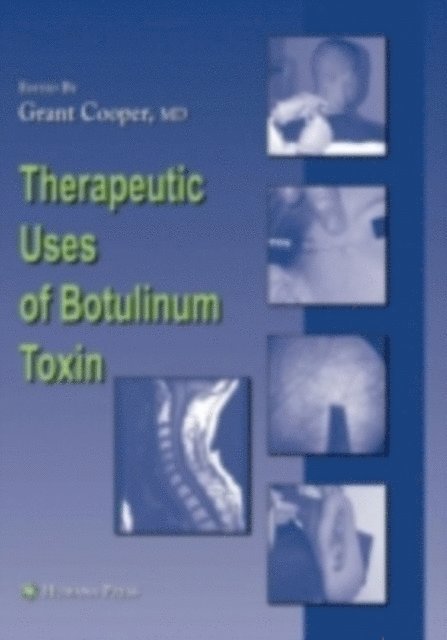 Grant Cooper - Therapeutic Uses of Botulinum Toxin, E-bok