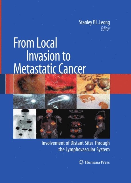 Stanley P. L. Leong - From Local Invasion to Metastatic Cancer, E-bok