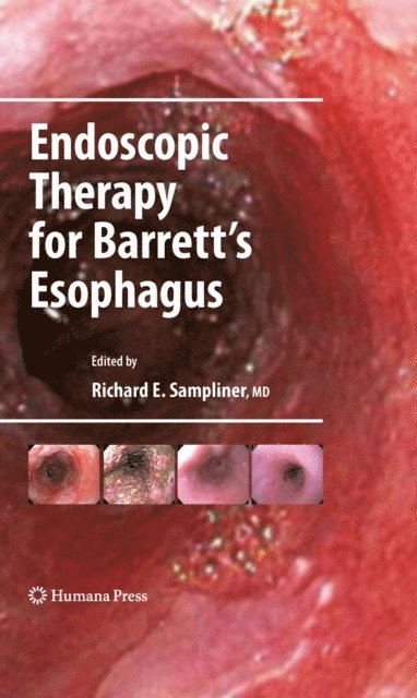 Richard E. Sampliner - Endoscopic Therapy for Barrett's Esophagus, E-bok