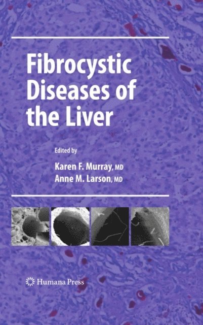 Anne M. Larson, Karen F. Murray - Fibrocystic Diseases of the Liver, E-bok