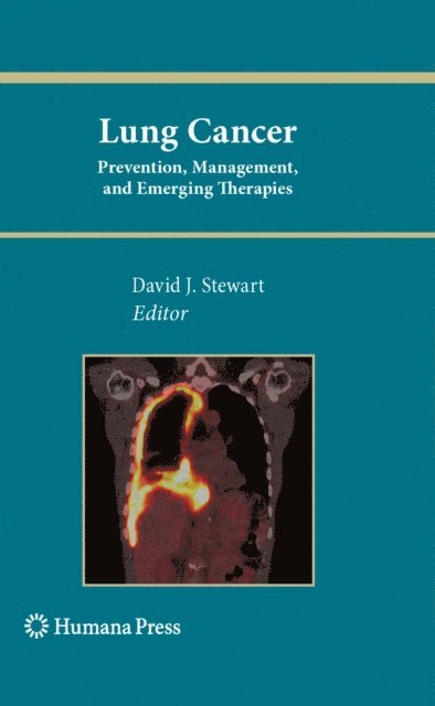 David J. Stewart - Lung Cancer:, E-bok