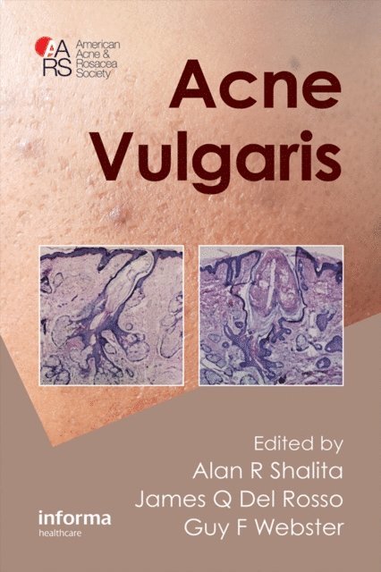 Guy Webster, James Q. Del Rosso, Alan R. Shalita - Acne Vulgaris, E-bok
