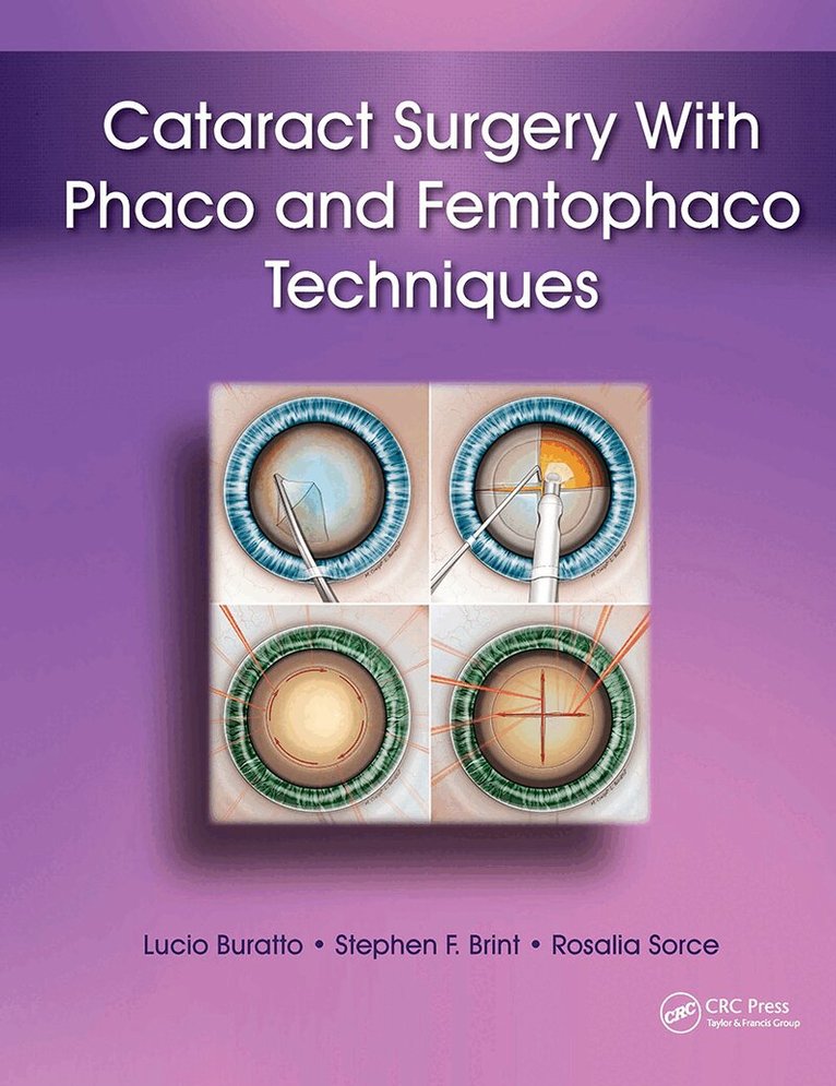 Lucio Buratto, Stephen Brint, Rosalia Sorce - Cataract Surgery With Phaco and Femtophaco Techniques, Inbunden. Tillgänglighet: Lägg i varukorg