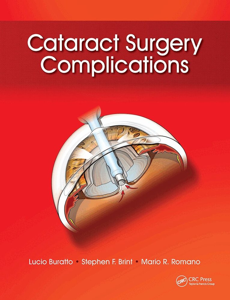 Lucio Buratto, Stephen Brint, Mario Romano - Cataract Surgery Complications, Inbunden. Tillgänglighet: Lägg i varukorg