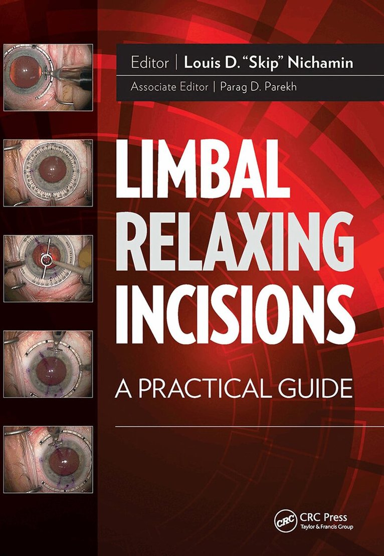 Louis Nichamin - Limbal Relaxing Incisions, Häftad. Tillgänglighet: Lägg i varukorg