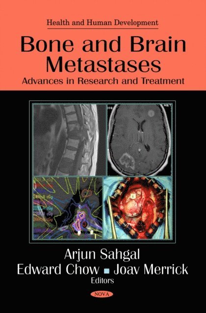 Arjun Sahgal - Bone and Brain Metastases: Advances in Research and Treatment, E-bok