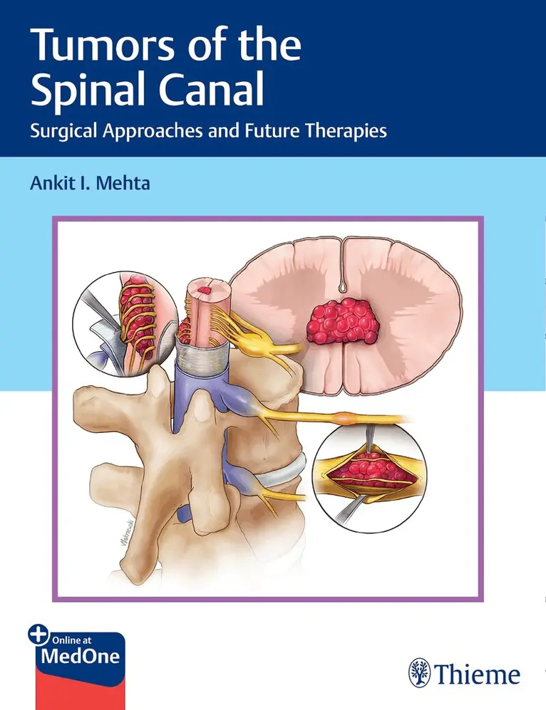 Ankit I. Mehta - Tumors of the Spinal Canal. Tillgänglighet: Lägg i varukorg