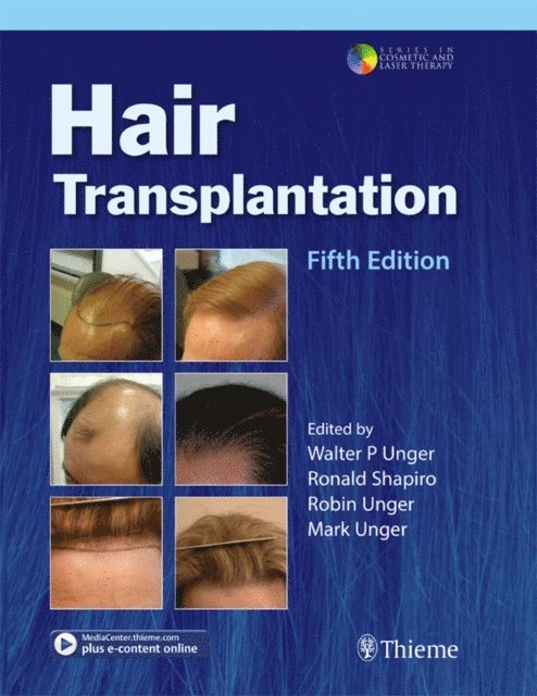 Robin Unger, Ronald Shapiro, Walter P. Unger - Hair Transplantation, E-bok