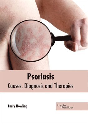 Emily Howling - Psoriasis: Causes, Diagnosis and Therapies, Inbunden. Tillgänglighet: Lägg i varukorg