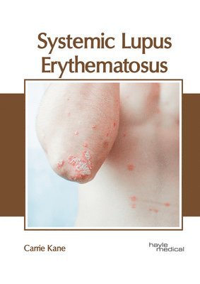 Carrie Kane - Systemic Lupus Erythematosus, Inbunden. Tillgänglighet: Lägg i varukorg