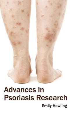 Emily Howling - Advances in Psoriasis Research, Inbunden. Tillgänglighet: Lägg i varukorg
