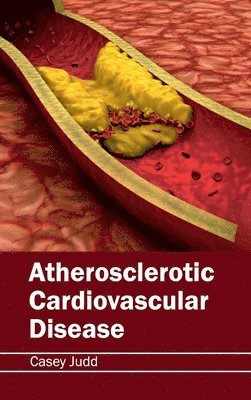 Casey Judd - Atherosclerotic Cardiovascular Disease, Inbunden. Tillgänglighet: Lägg i varukorg