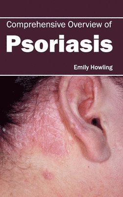 Emily Howling - Comprehensive Overview of Psoriasis, Inbunden. Tillgänglighet: Lägg i varukorg