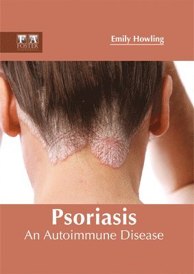 Emily Howling - Psoriasis: An Autoimmune Disease, Inbunden. Tillgänglighet: Lägg i varukorg