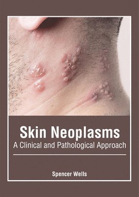 Spencer Wells - Skin Neoplasms: A Clinical and Pathological Approach, Inbunden. Tillgänglighet: Lägg i varukorg