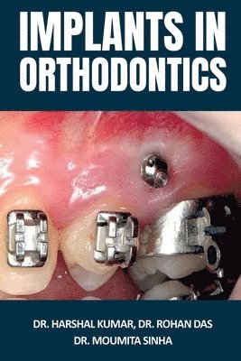 Dr Harshal Kumar, Dr Rohan Das and Dr Moumita Sinha - Implants in Orthodontics, Häftad