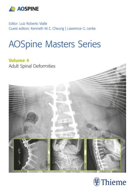 Kenneth M.C. Cheung, Lawrence G Lenke - AOSpine Masters Series, Volume 4: Adult Spinal Deformities, E-bok