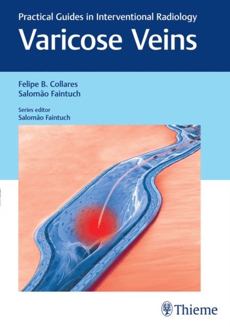 Salomao Faintuch, Felipe Collares - Varicose Veins, E-bok