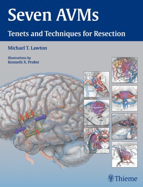 Michael T. Lawton - Seven AVMs, E-bok