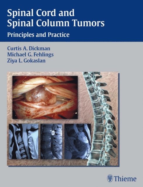 Ziya L. Gokaslan, Michael G. Fehlings, Curtis A. Dickman - Spinal Cord and Spinal Column Tumors, E-bok
