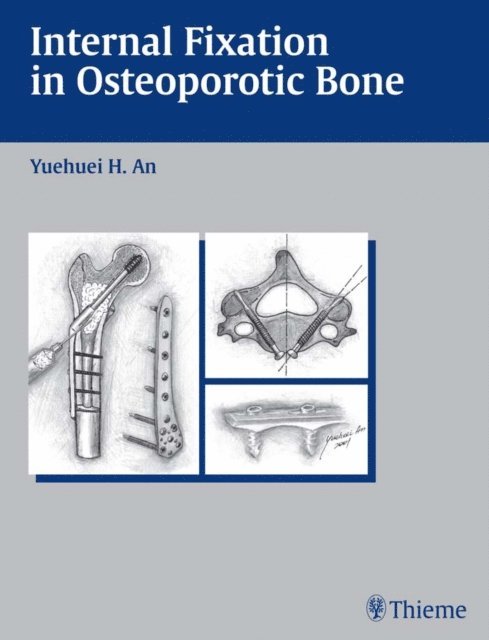 Yuehuei H. An - Internal Fixation in Osteoporotic Bone, E-bok. Tillgänglighet: Lägg i varukorg