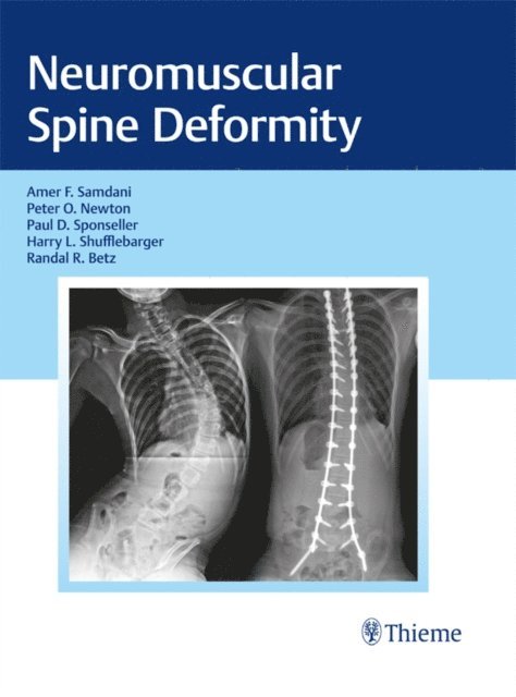 Randal R. Betz, Harry L. Shufflebarger, Paul D. Sponseller, Peter O. Newton, Amer F. Samdani - Neuromuscular Spine Deformity, E-bok