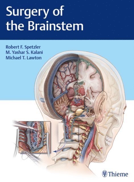 Michael T. Lawton, M. Yashar S. Kalani, Robert F. Spetzler - Surgery of the Brainstem, E-bok