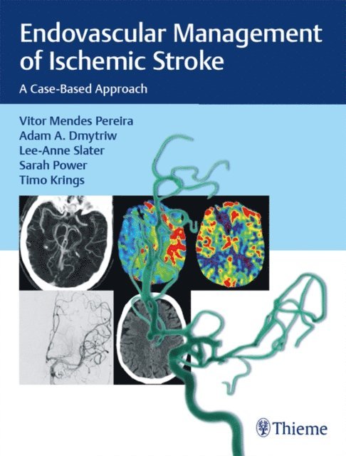 Timo Krings, Sarah Power, Lee-Anne Slater, Adam A. Dmytriw, Vitor Mendes Pereira - Endovascular Management of Ischemic Stroke, E-bok