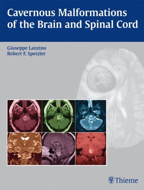 Robert F. Spetzler, Giuseppe Lanzino - Cavernous Malformations of the Brain and Spinal Cord, E-bok