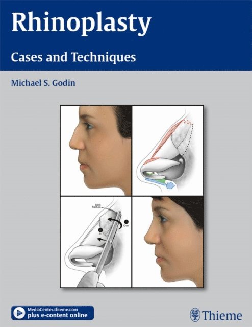 Michael S. Godin - Rhinoplasty, E-bok