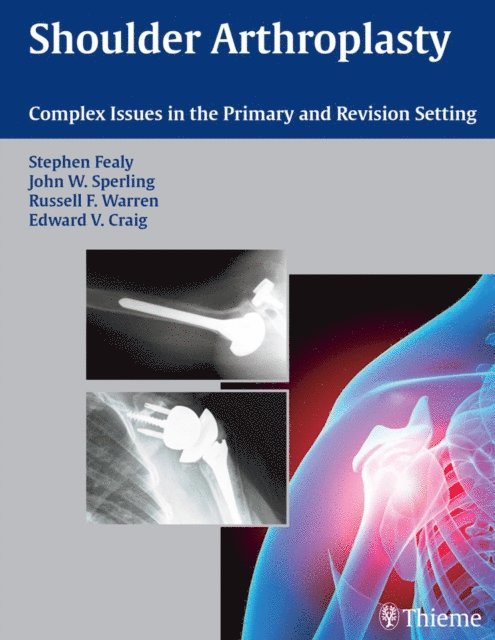 Edward V. Craig, Russell F. Warren, John W. Sperling, Stephen Fealy - Shoulder Arthroplasty, E-bok