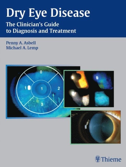 Michael A. Lemp, Penny A. Asbell - Dry Eye Disease, E-bok