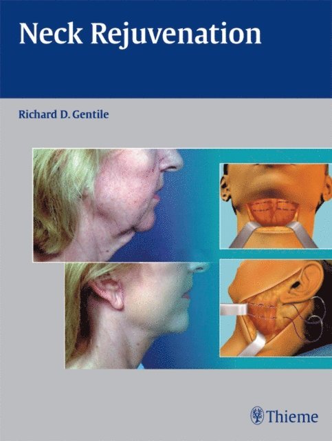 Richard D. Gentile - Neck Rejuvenation, E-bok