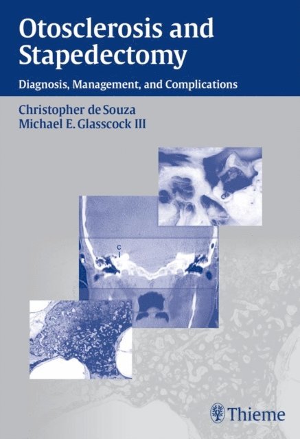 Michael E. Glasscock, Christopher De Souza - Otosclerosis and Stapedectomy, E-bok