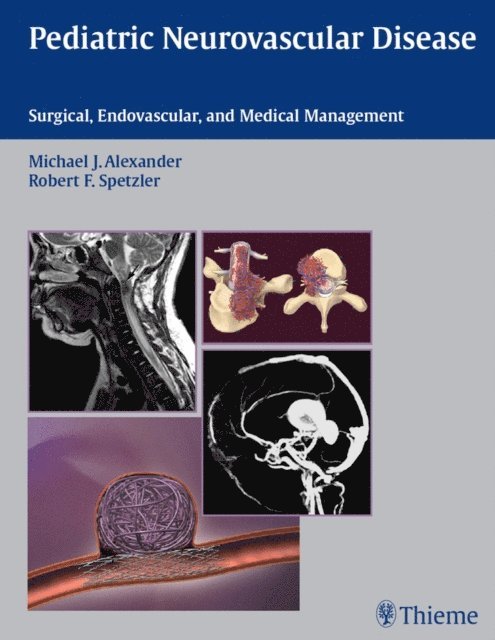 Robert F. Spetzler, Michael J. Alexander - Pediatric Neurovascular Disease, E-bok
