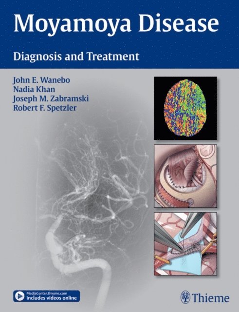 Robert F. Spetzler, Joseph M. Zabramski, Nadia Khan, John E. Wanebo - Moyamoya Disease, E-bok