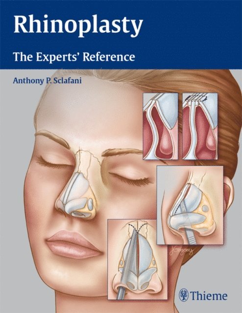 Anthony P. Sclafani - Rhinoplasty, E-bok