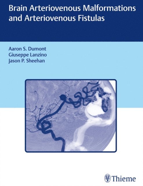 Jason P Sheehan, Giuseppe Lanzino, Aaron S. Dumont - Brain Arteriovenous Malformations and Arteriovenous Fistulas, E-bok