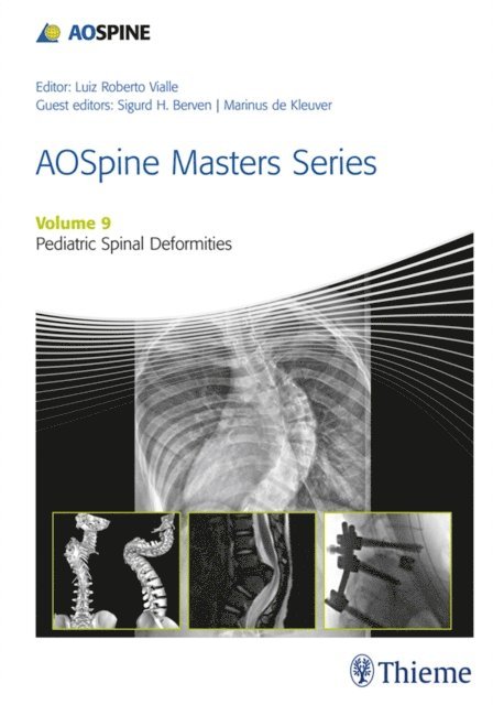 Marinus de Kleuver, Sigurd H Berven - AOSpine Masters Series, Volume 9: Pediatric Spinal Deformities, E-bok